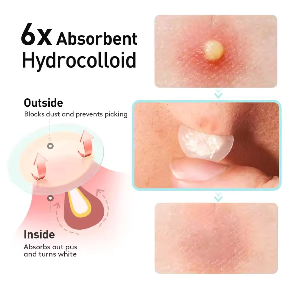 360 pieces/box acne patches -  - Essential Oils review and price